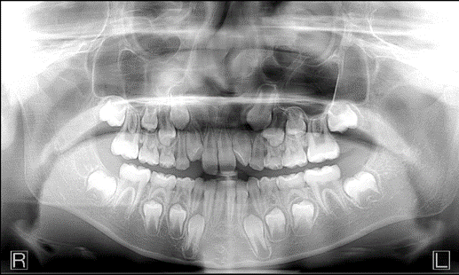digital dental panoramic x-ray machine bite wings