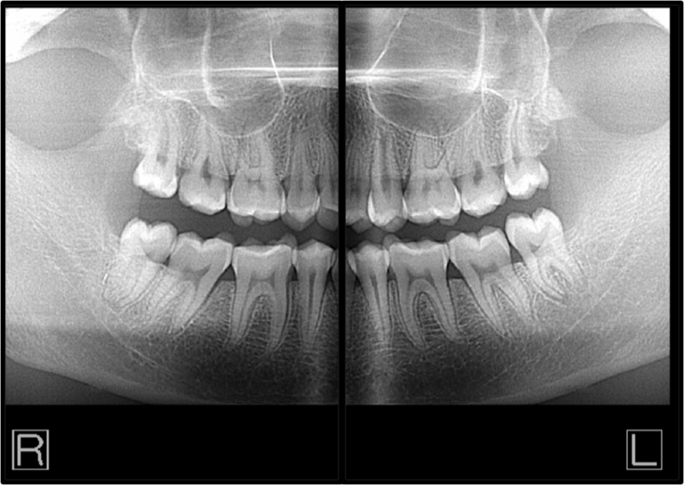 Can Dental Radiographs Indicate Risk of Dementia?